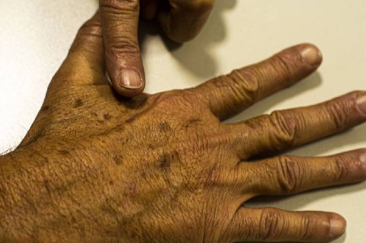 Desinformação sobre câncer de pele afeta diagnóstico, diz instituição